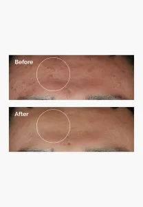 مایع سرم پوست ضد لک نیاسینامید 10% و زینک 1% اوردینری 30 میلیلیتر 7 1 18